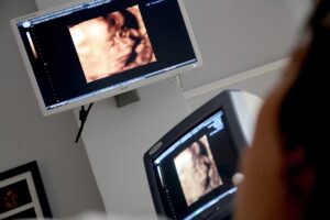 Nowoczesne rozwiązania w diagnostyce medycznej: Aparat USG ACUSON Siemens Juniper